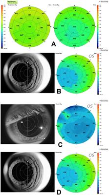 Corneal stromal mapping characteristics in normal corneas using anterior segment SD-OCT